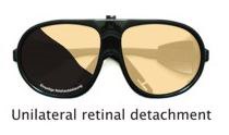 utilateral retina detachment